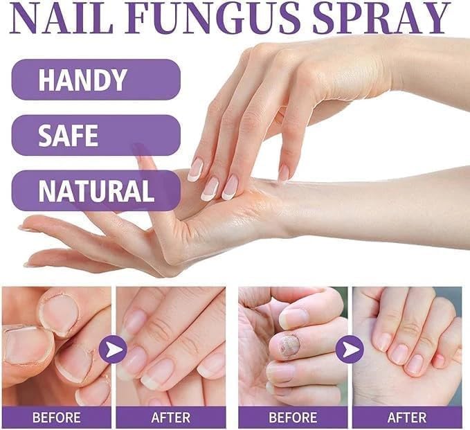 Nail Fungus Treatment Spray (Clinically Approved)