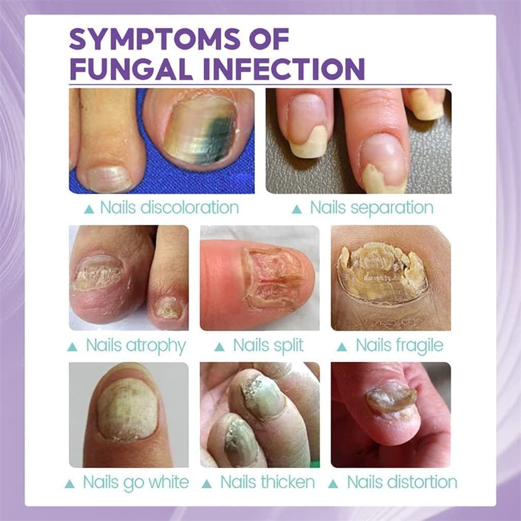 Nail Fungus Treatment Spray (Clinically Approved)