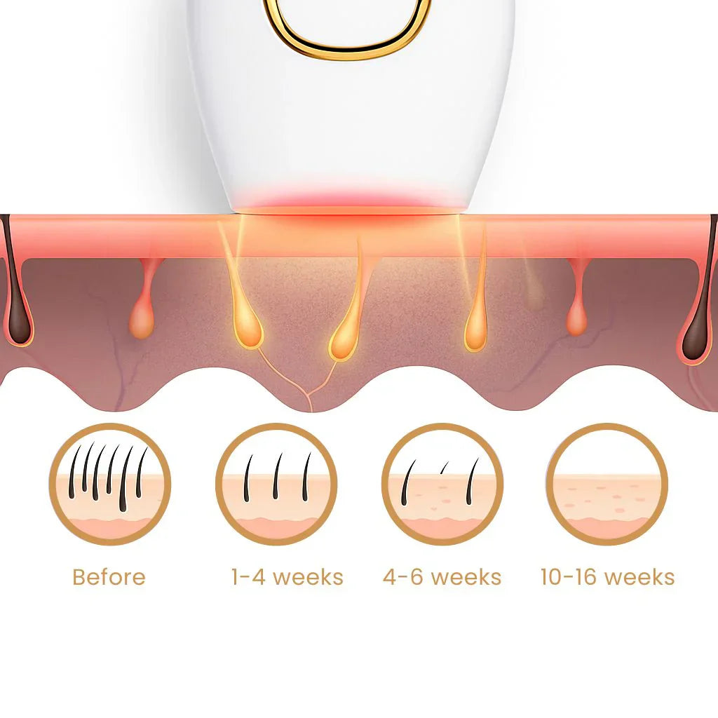 IPL Laser Hair removal