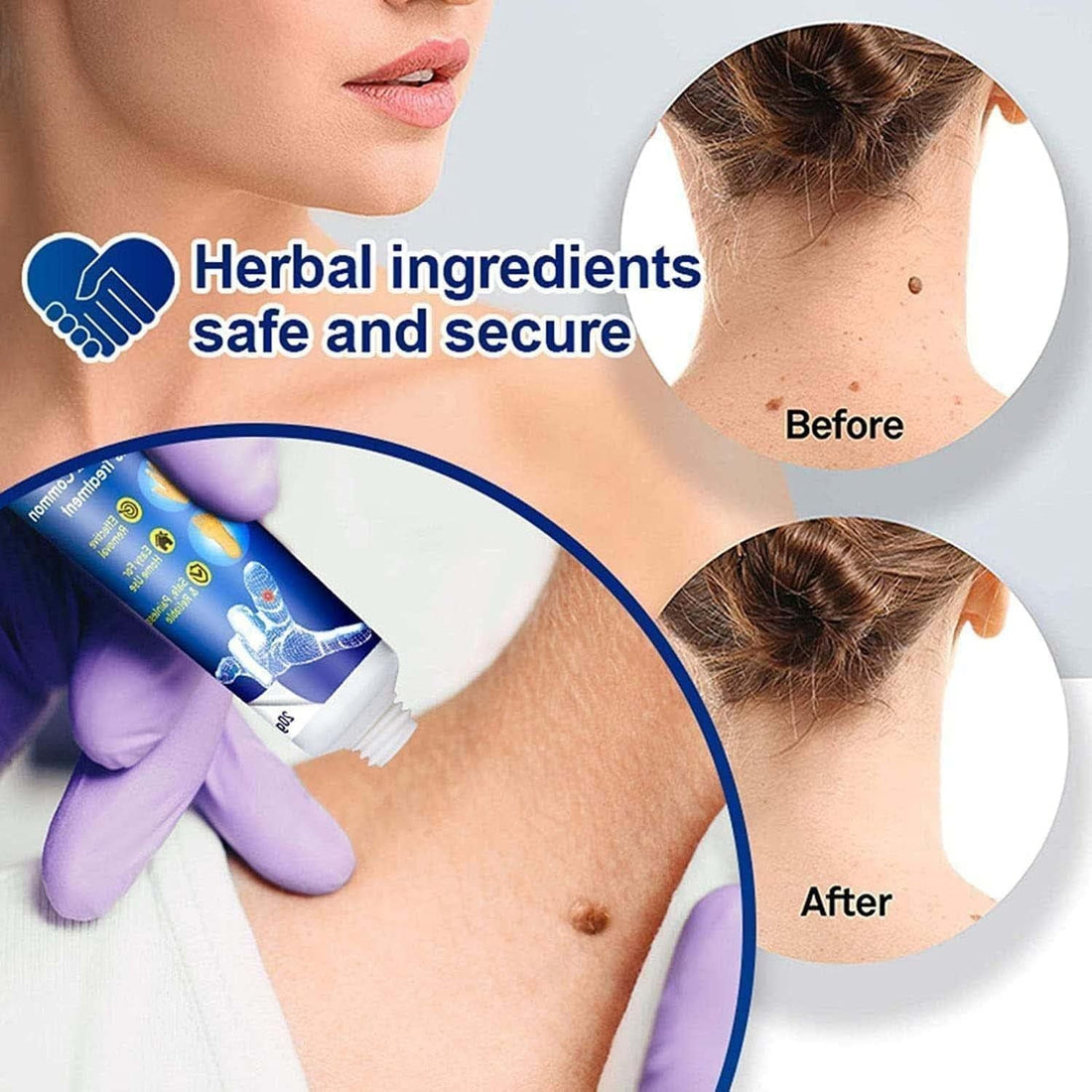 Wart Removal Ointment Cream Common Wart for Body Skin Tag Remover and Face Skin Tag Remover